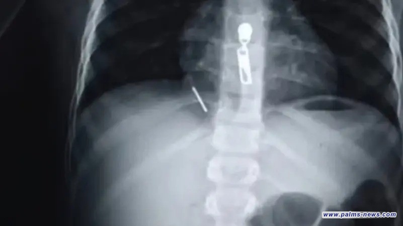 ابتلع مسماراً اخترق الرئة ووصل القلب.. فريق طبي ينقذ طفلاً في مصر